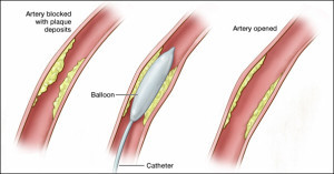 Angioplasty-latest technology for better results