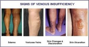 Signs of venous insufficiency