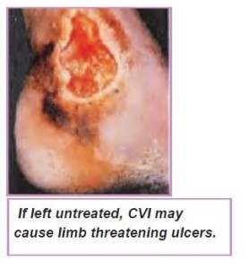 Limb threatening ulcers