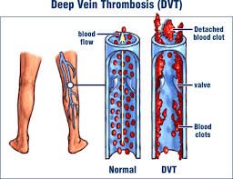 Deep-Vein Thrombosis