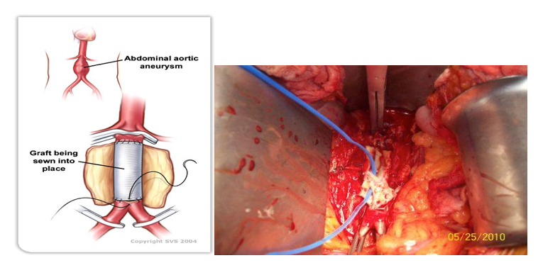 Abdominal Aortic Aneurysm open surgery