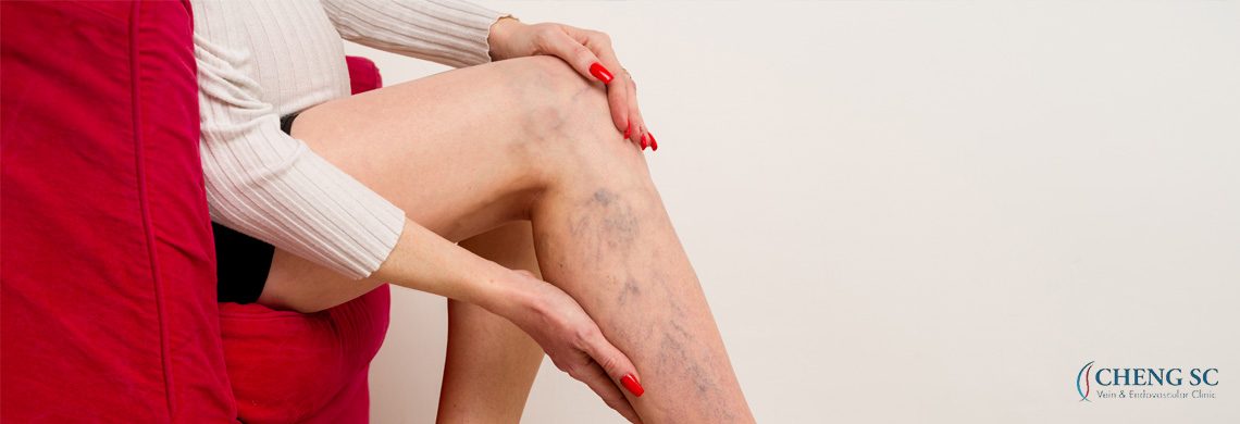 Why You Should Not Ignore Spider Veins