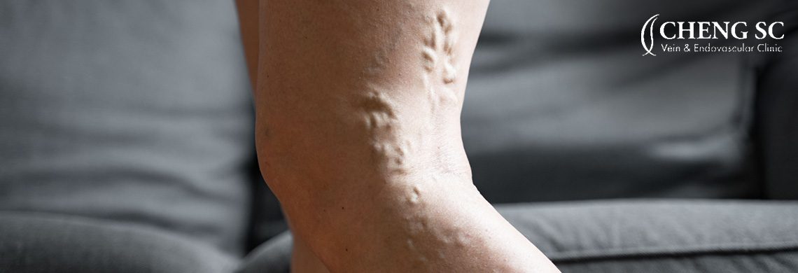 Women's Leg With Varicose Veins