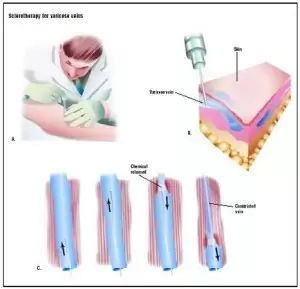 Sclerotherapy