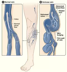 Illustration comparing normal veins and varicose veins in the leg.