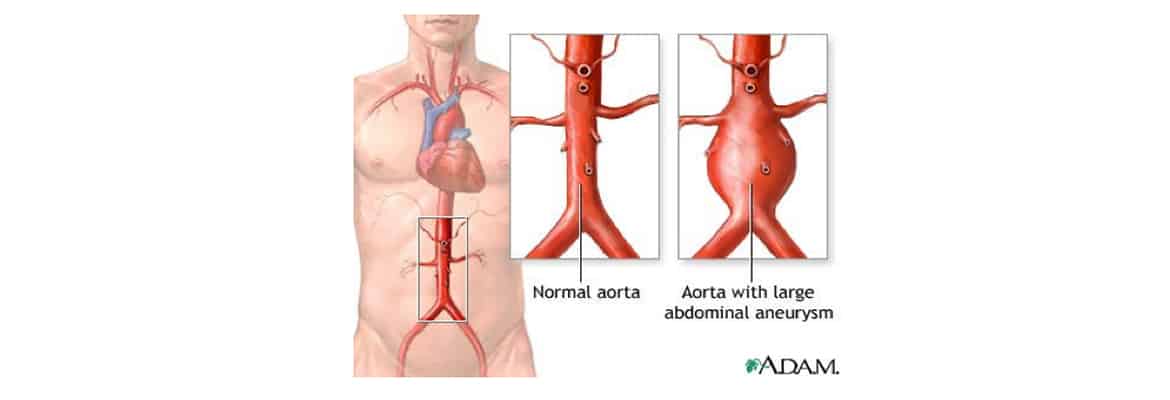 Abdominal Aortic Aneurysm Stenting