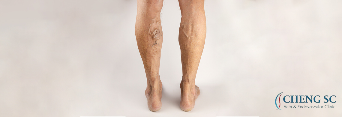 Exploring The Risks of Untreated Varicose Veins – Cheng SC
