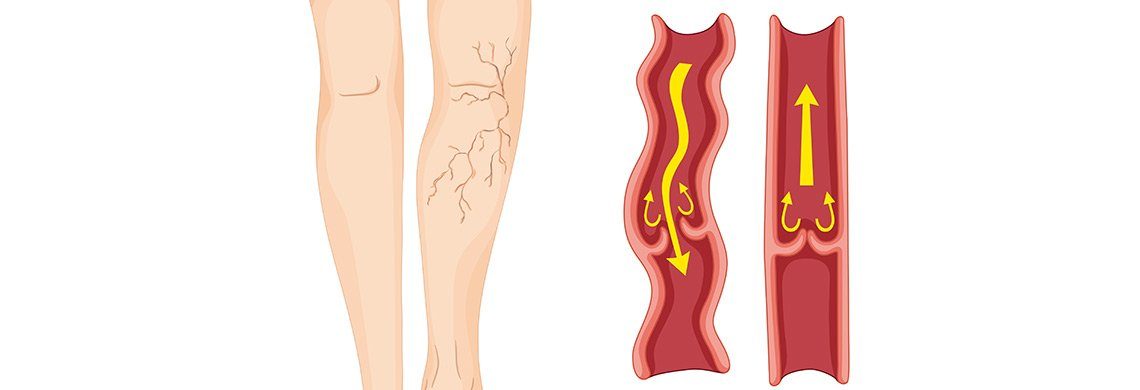 Laser, Radiofrequency, Chemicals and “Glue” what treatment is best for my Varicose veins?
