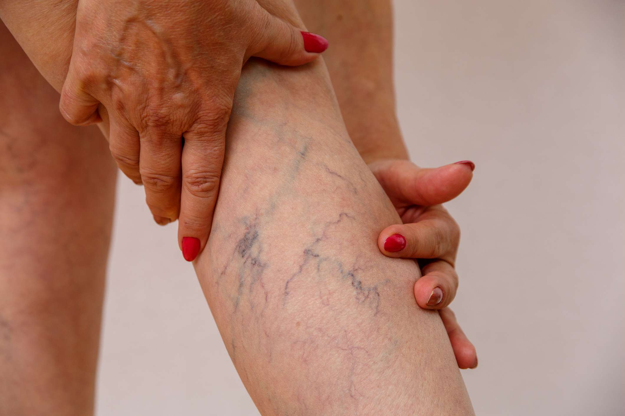 all you need to know about varicose veins in singapore