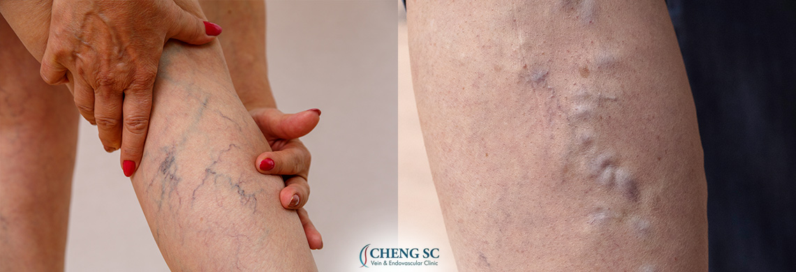 Varicose Veins VS Spider Veins: Similarities and Differences